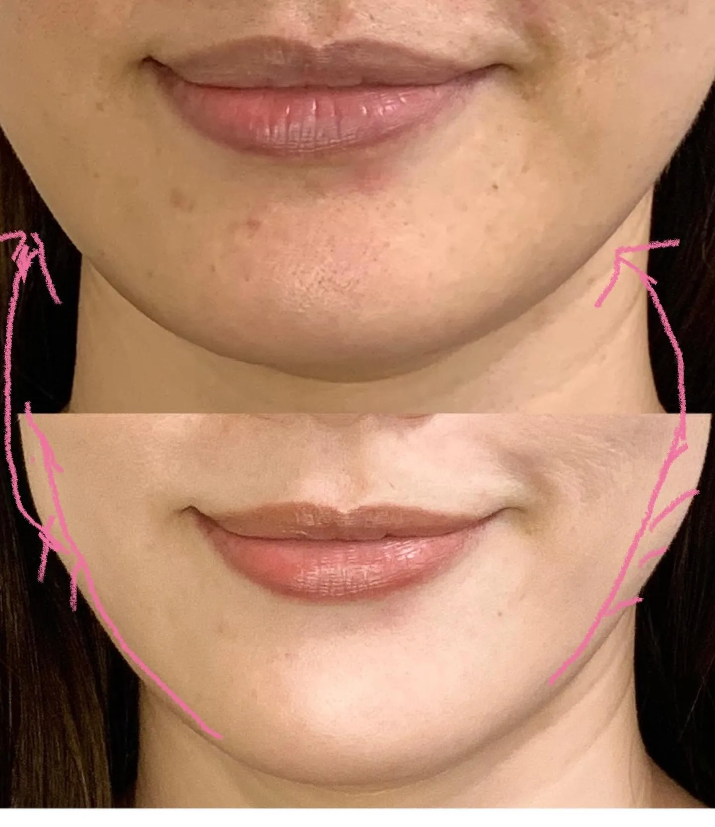 フェイシャル/リフトアップ